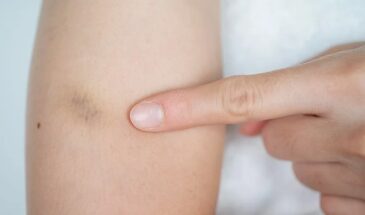 4 натуральных способа мгновенно избавиться от синяка — проверено на себе!