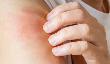 Как снять зуд за секунды и не попасть в реанимацию после укуса пчелы, осы или клеща
